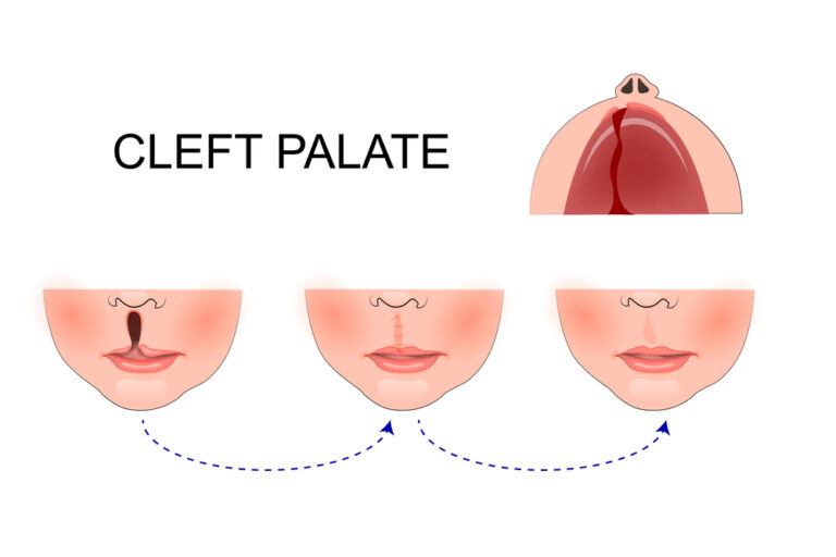 labio leporino fenda labiopalatina