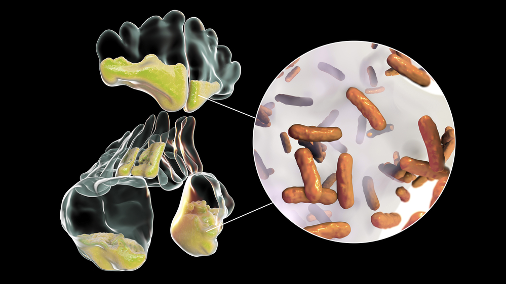 Rinossinusite virus Rinossinusite virus