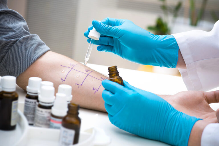 prick test alergia prick test alergia
