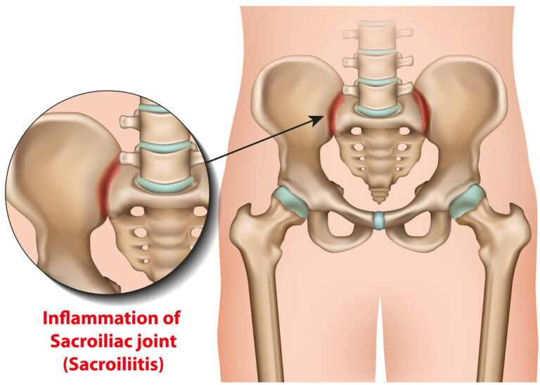 sacroiliitis sacroiliitis