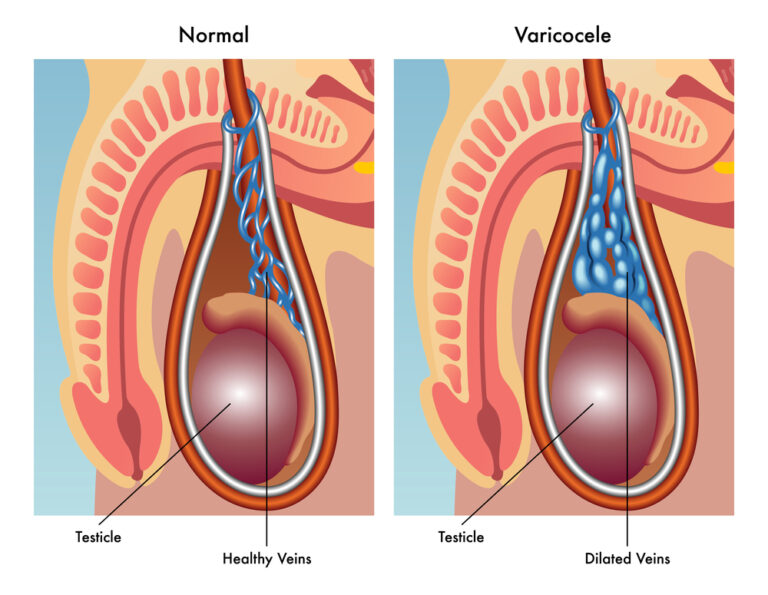 cirurgia de varicocele