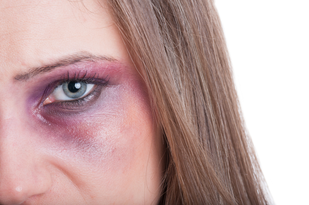 tratamento Tirar roxo do olho tratamento Tirar roxo do olho