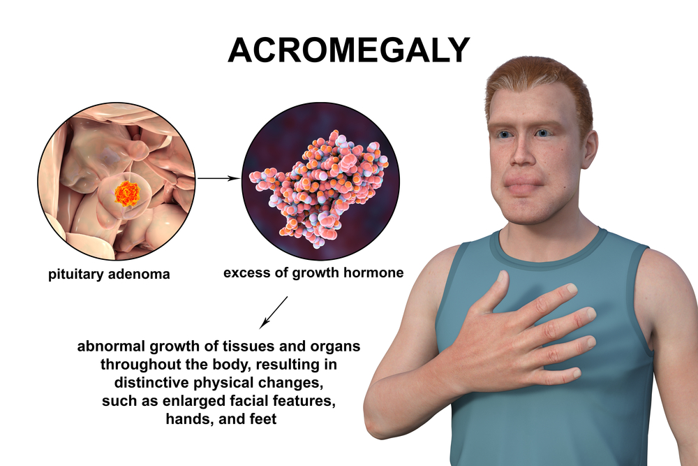 Acromegalia Acromegalia