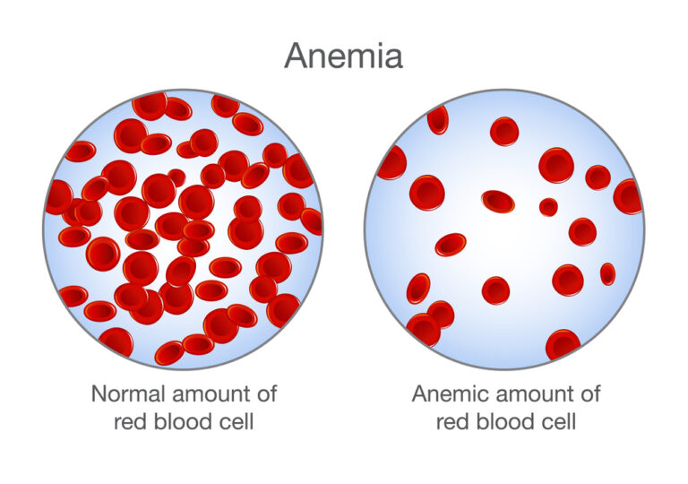 Anemia cronica