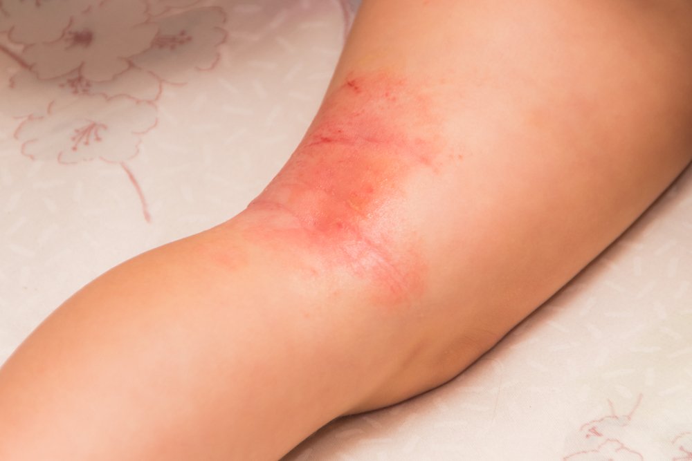 infeccoes fungicas da pele infecções fúngicas da pele
