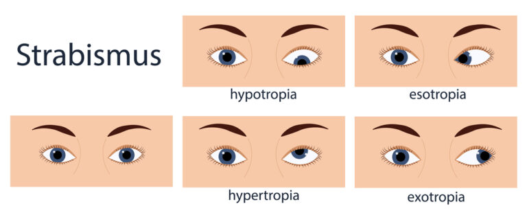 sintomas de Estrabismo infantil sintomas de Estrabismo infantil